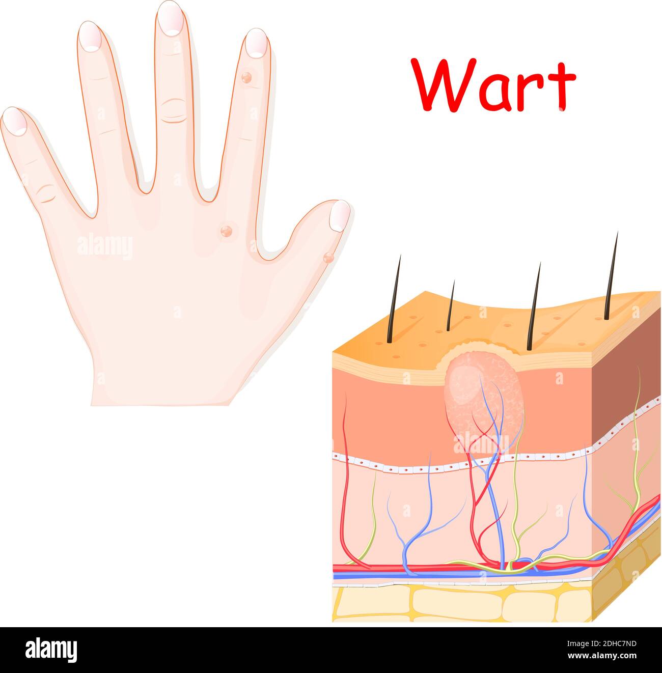 verruche su una mano. sezione trasversale di verruca dettagliata. Illustrazione vettoriale per uso medico Illustrazione Vettoriale