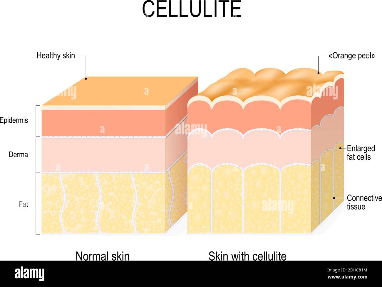 cellulite. Sezione trasversale di una pelle sana e buccia d'arancia. Illustrazione vettoriale per uso medico, educativo, biologicico e scientifico. Cura della pelle Illustrazione Vettoriale