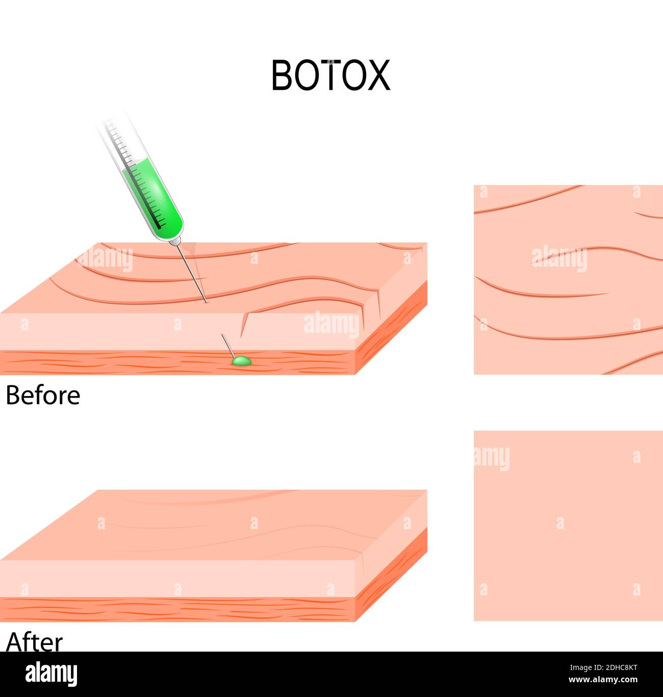 Applicazioni di riempimento cosmetico Botox. Per la riduzione delle rughe facciali. Iniezione di botox nei muscoli sotto le rughe facciali Illustrazione Vettoriale