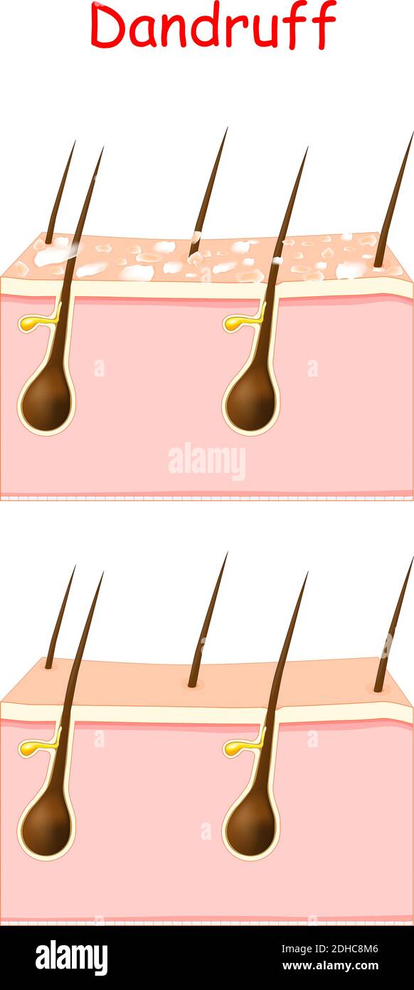Forfora sui capelli prima e dopo il trattamento. Dermatite seborroica può accadere a causa della pelle asciutta, batteri e funghi sul cuoio capelluto Illustrazione Vettoriale