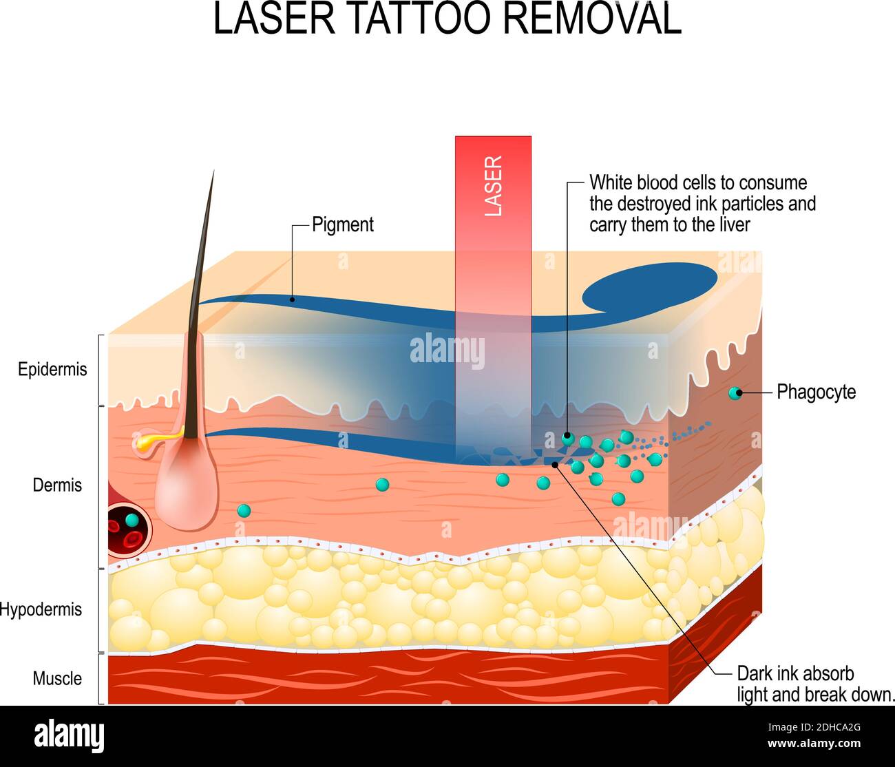Rimozione del tatuaggio laser. Come funziona la rimozione del tatuaggio laser. L'inchiostro scuro assorbe la luce e si rompe Illustrazione Vettoriale