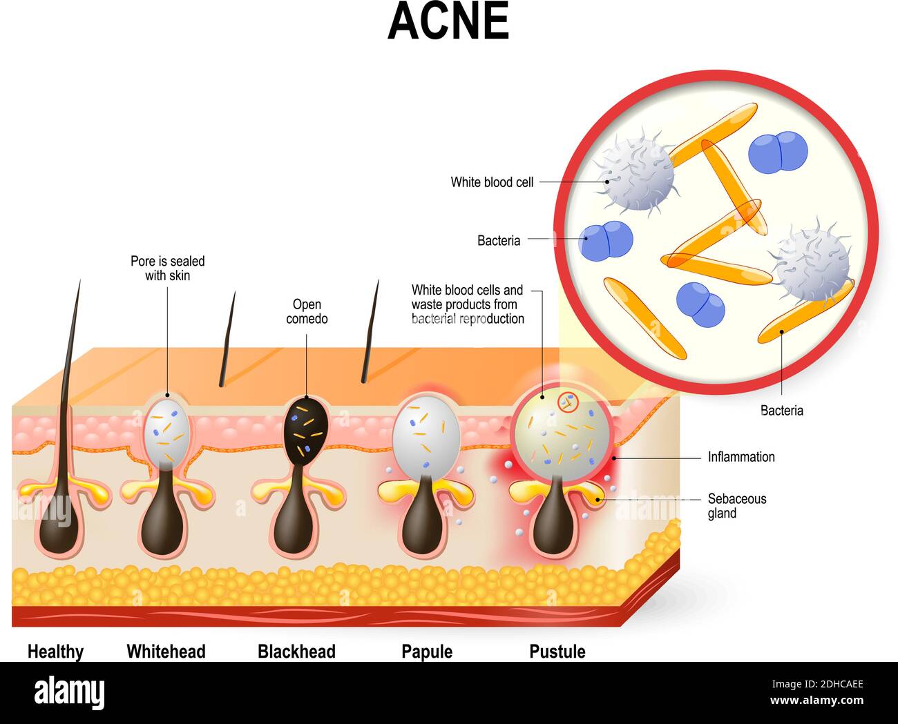 Vulgaris o pimple dell'acne. Il sebo e le cellule morte della pelle nel poro intasato favoriscono la crescita di un certo batterio Illustrazione Vettoriale