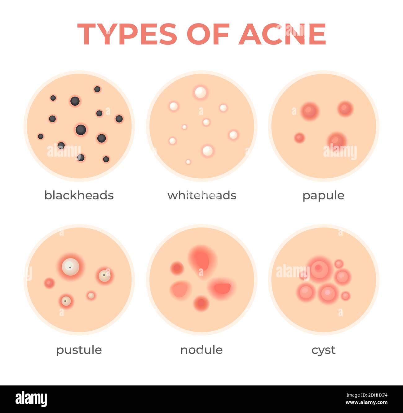 Tipi di acne. Problema di infezione della pelle, cisti di tipo e grado dei pimples, whitehead, blackheads, nodulo e cistico. Serie di vettori di malattia dei pori del derma Illustrazione Vettoriale