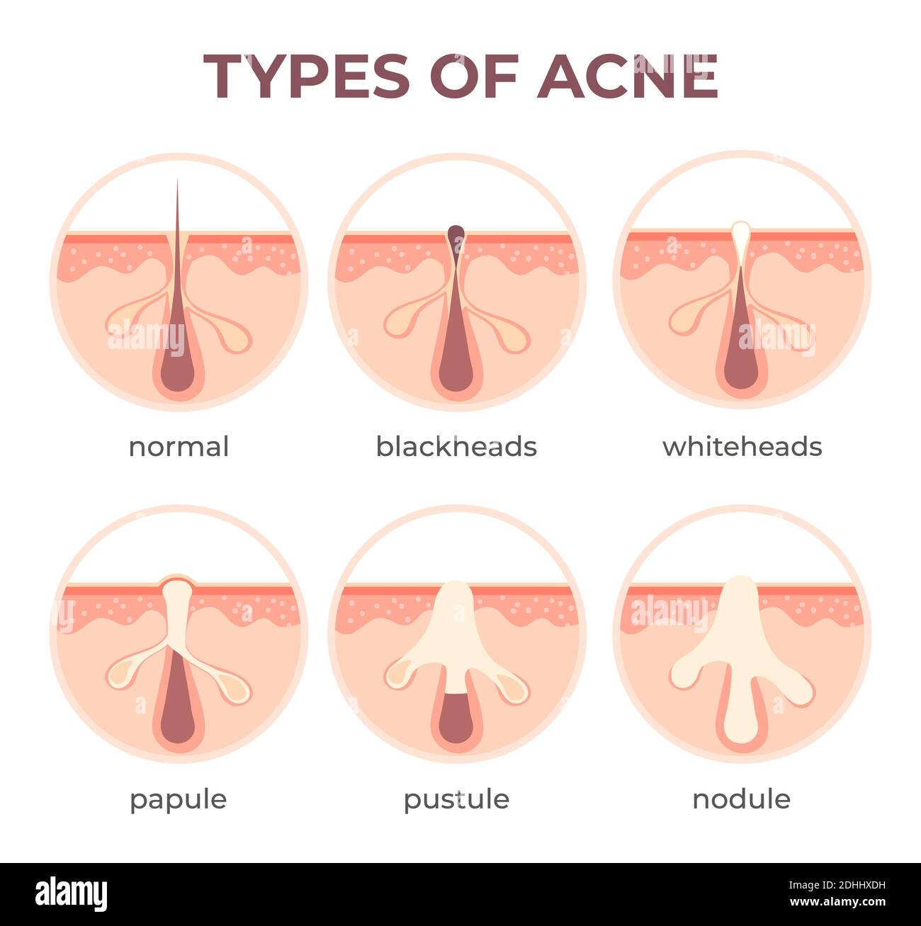 Anatomia dei tipi di acne. Pimple malattie vista in sezione testa nera, cistica e whitehead. Struttura infografica del vettore di infezione della pelle e dei pori Illustrazione Vettoriale