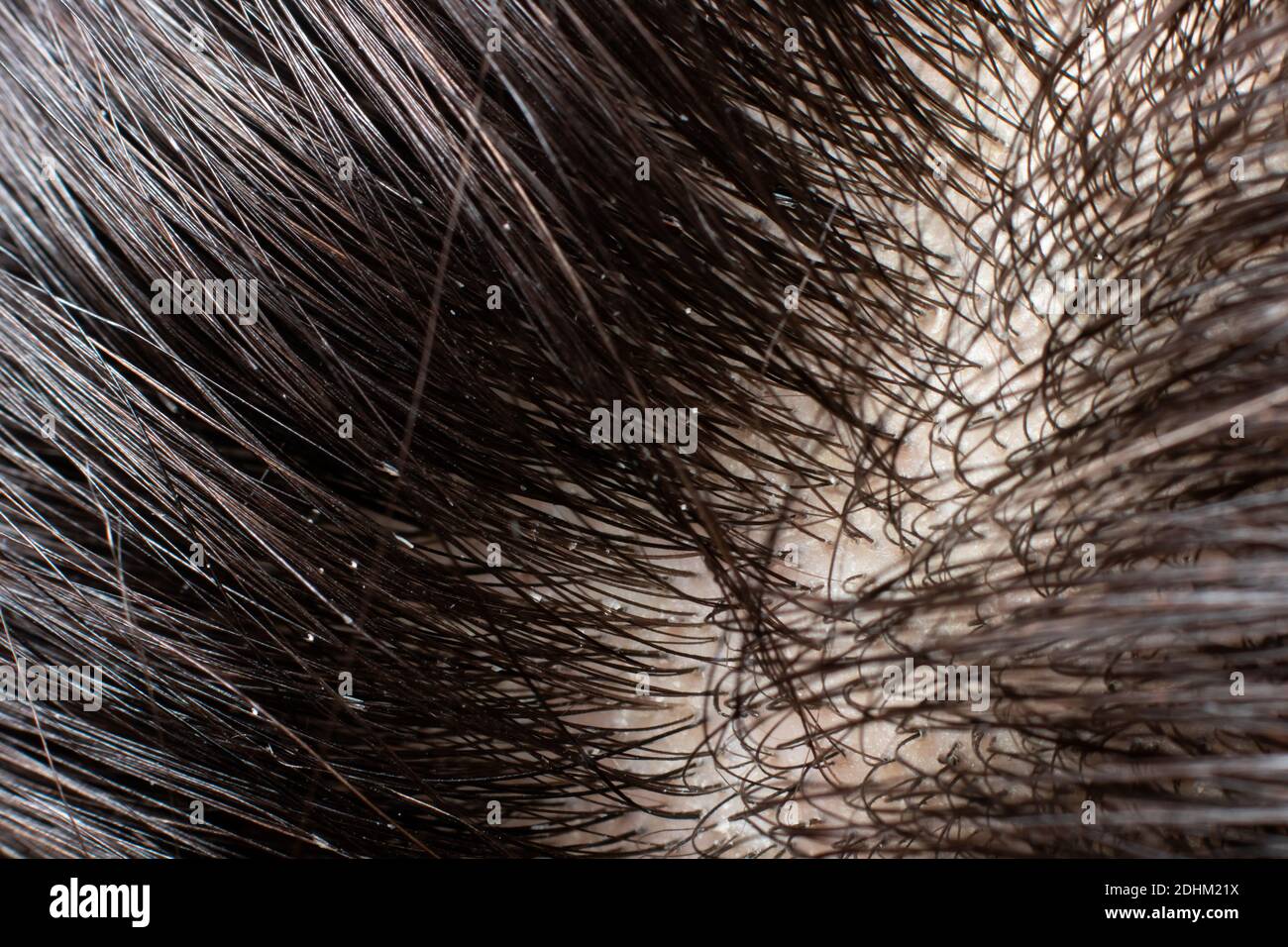 Capelli grassi sporchi di un uomo brunette con forfora. Cura dei capelli  con seborrea Foto stock - Alamy