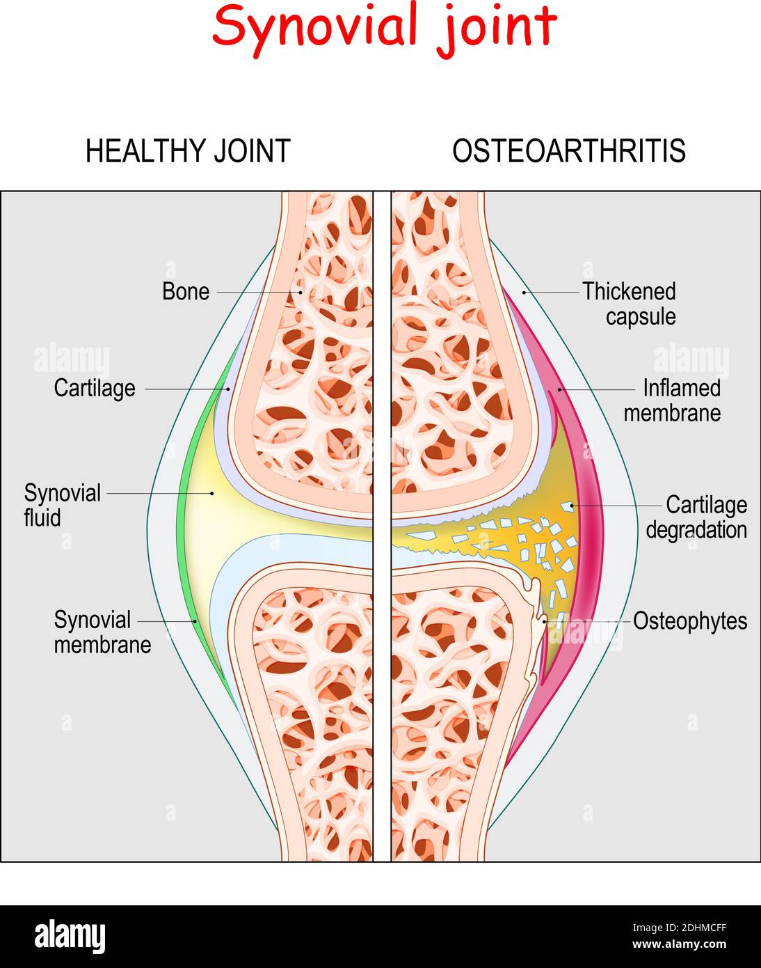 Osteoartrite. Articolazione sinoviale e ginocchio sani con artrite o dolore. Malattia degenerativa delle articolazioni Illustrazione Vettoriale