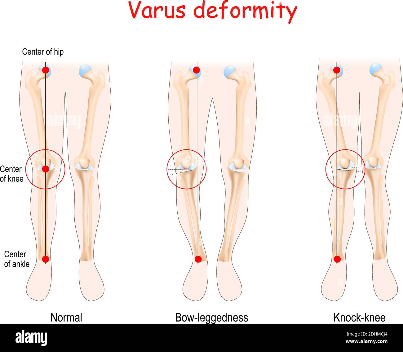 Deformità valgiche: Buona salute delle articolazioni, del ginocchio e della gamba. Gambe, ossa e articolazioni umane. Illustrazione Vettoriale