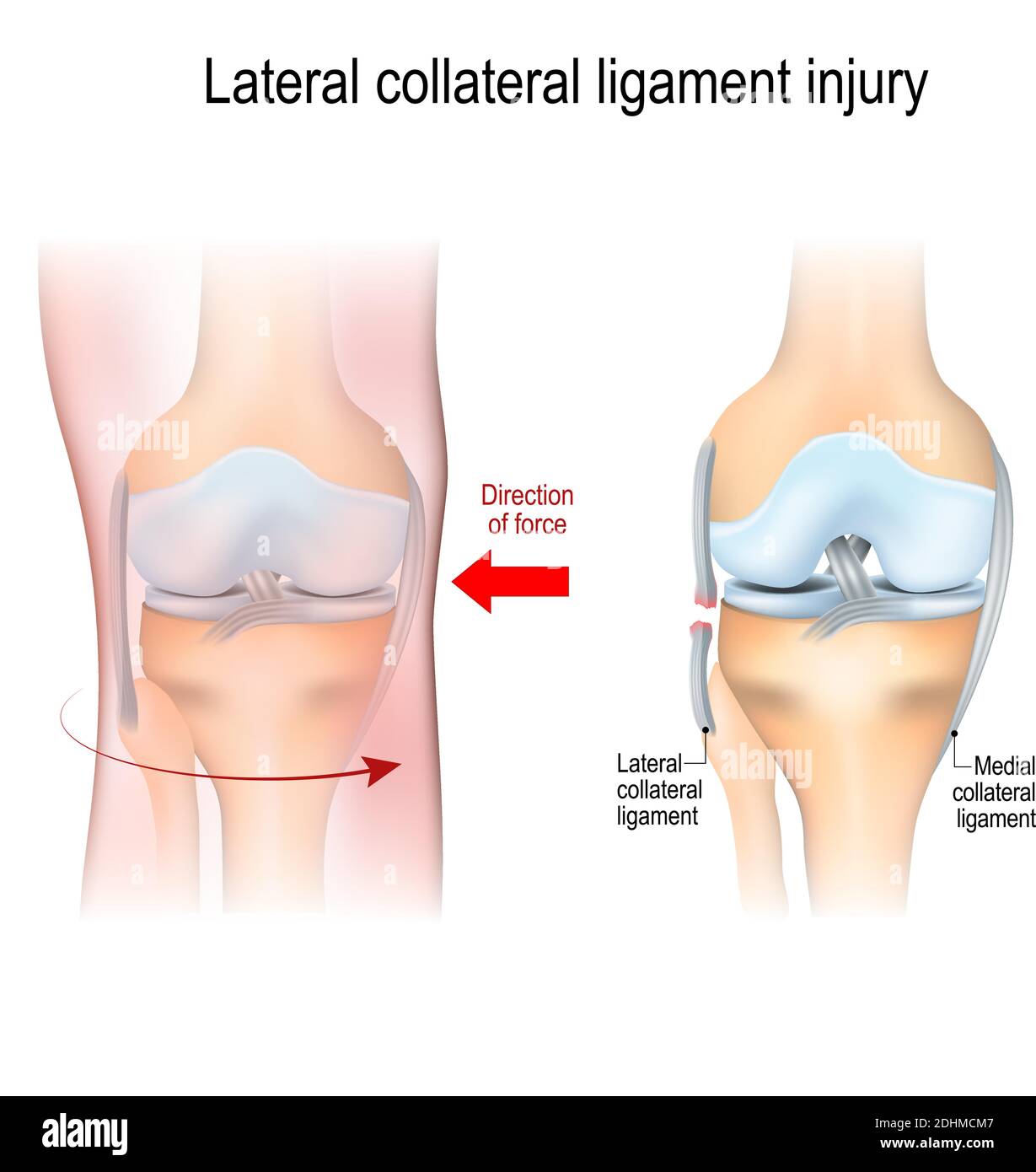 Lesione del legamento collaterale fibolare. Anatomia articolare. Illustrazione vettoriale per uso biologico, medico, scientifico ed educativo Illustrazione Vettoriale
