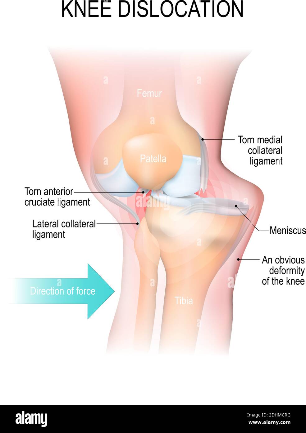 Dislocazione del ginocchio. Trauma laterale al ginocchio, lacerazione dei legamenti collaterali, lesione del legamento crociato e lesione del menisco Illustrazione Vettoriale