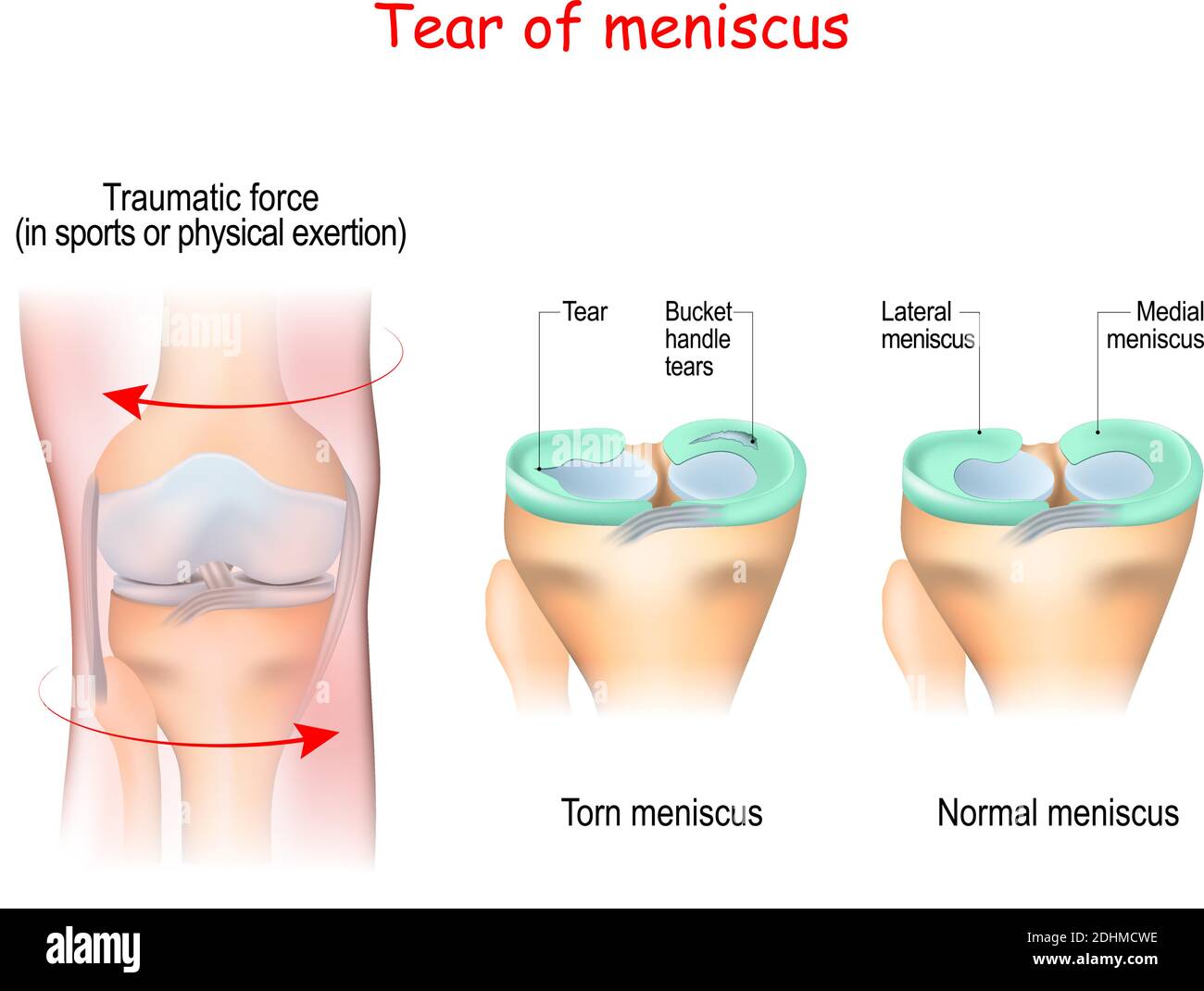 la rottura di un menisco è una rottura di una o più strisce di fibrocartilagine nel ginocchio. Articolazione umana, e forza traumatica Illustrazione Vettoriale