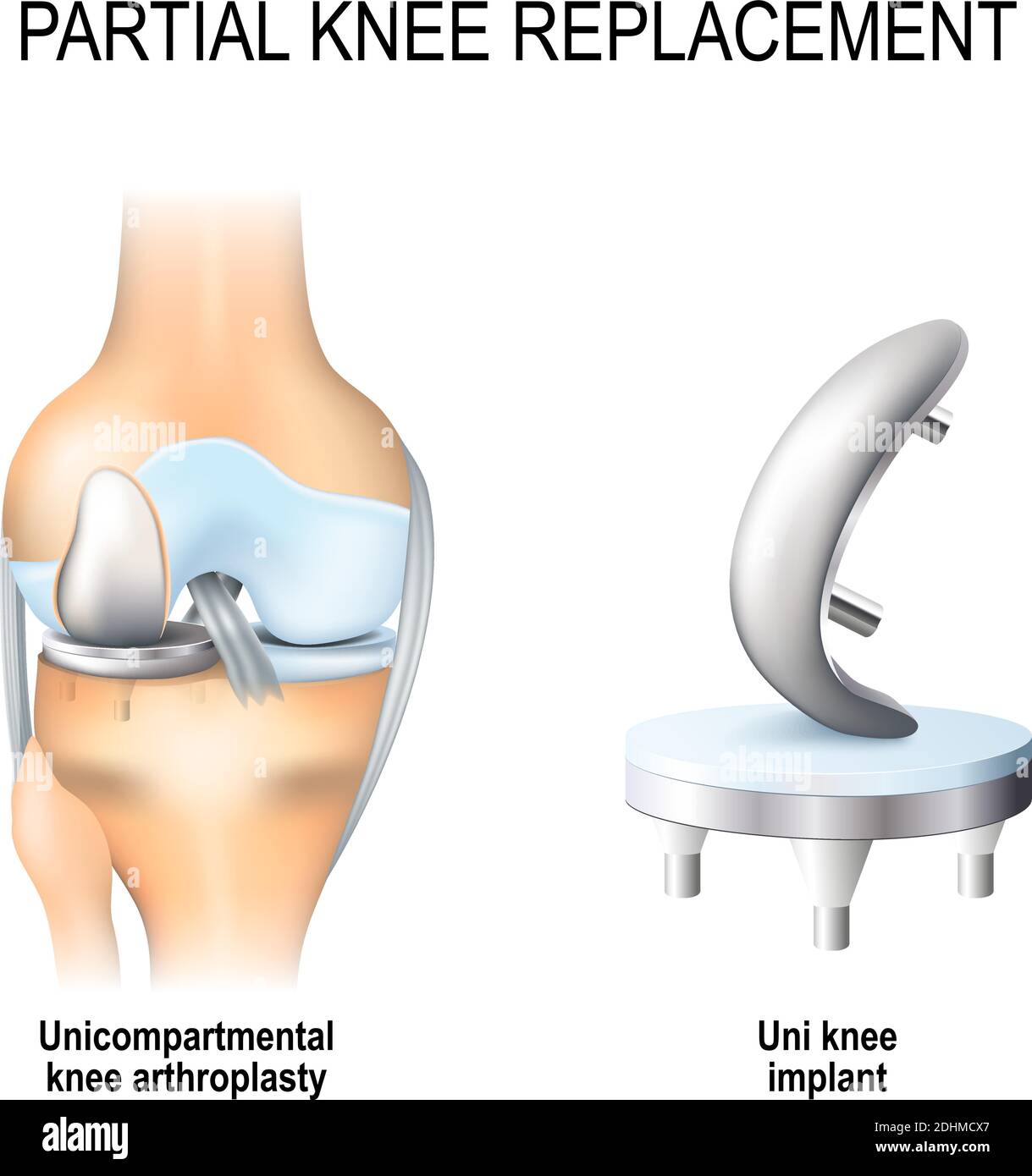 sostituzione parziale del ginocchio. artroplastica unicompartimentale del ginocchio e impianto uni del ginocchio Illustrazione Vettoriale