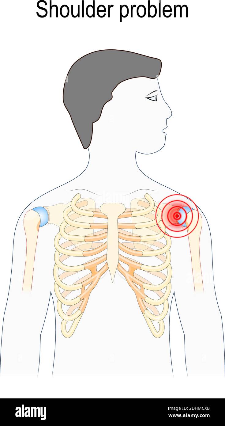 Problema di spalla. Silhouette umana con spalla evidenziata (colore rosso). Illustrazione vettoriale per la progettazione, l'istruzione, la biologia, l'uso scientifico Illustrazione Vettoriale