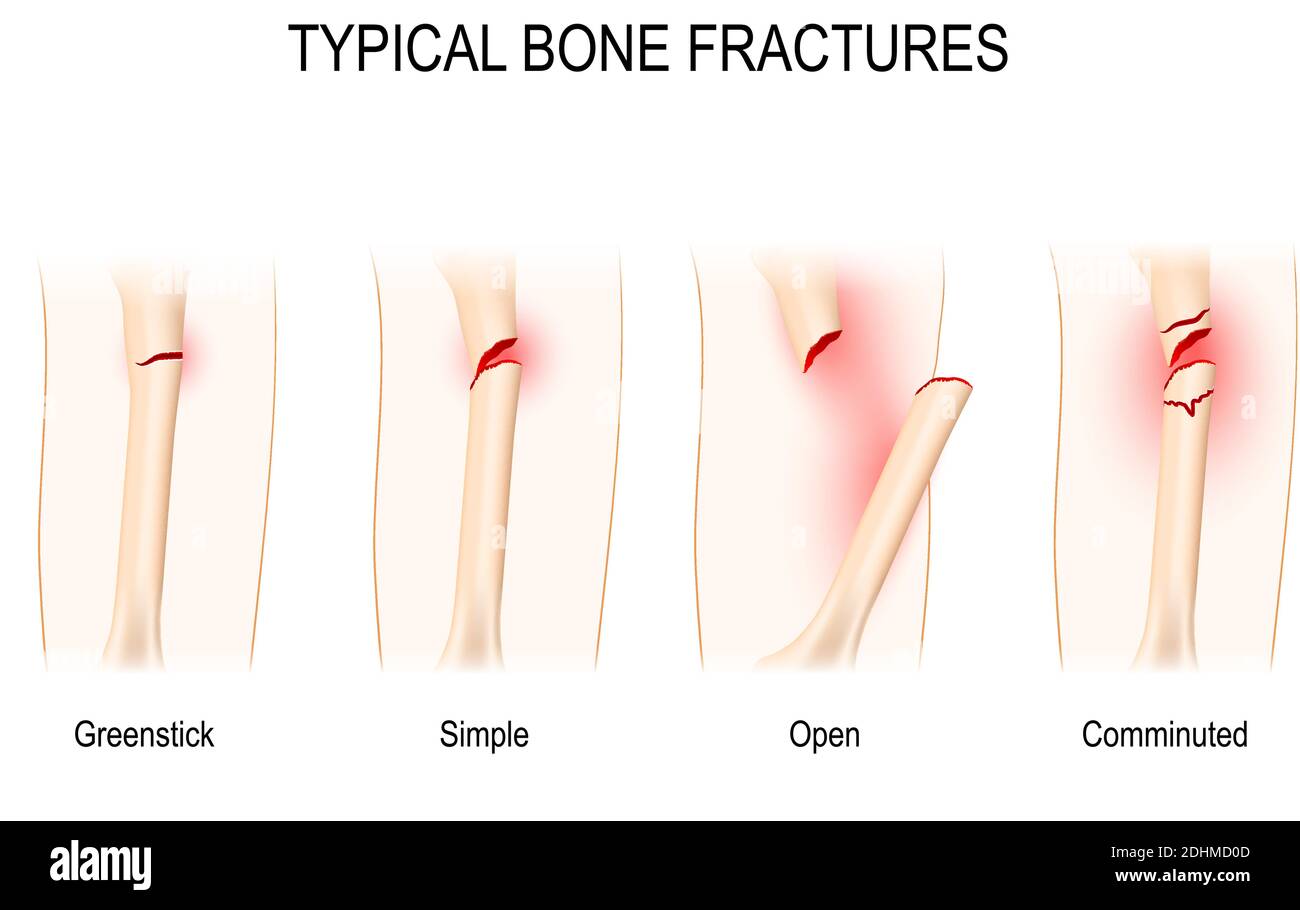 Fratture ossee tipiche: Greenstick, semplice, aperto, sminuzzato. Schema vettoriale per uso medico Illustrazione Vettoriale