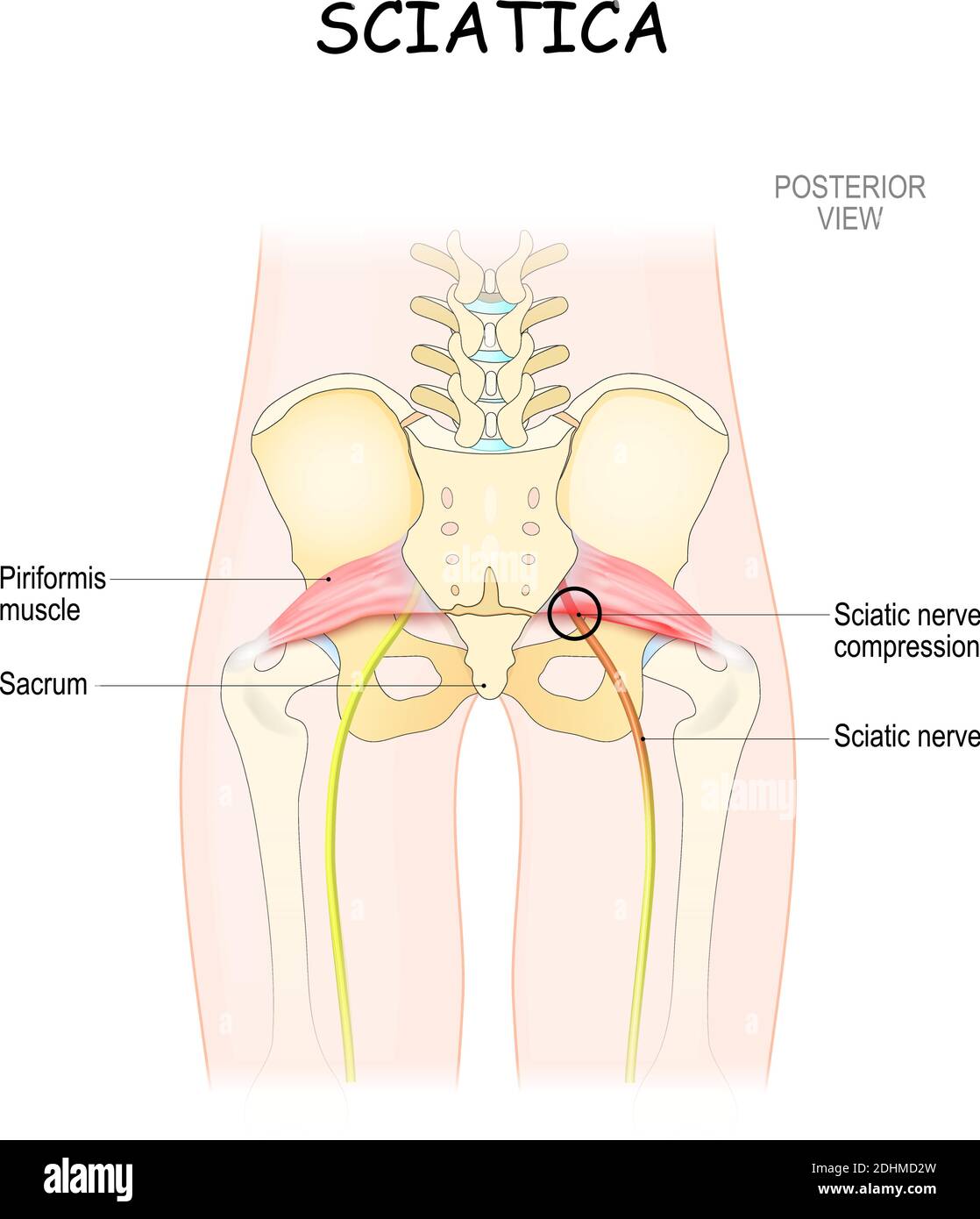 sindrome di piriformis. illustrazione vettoriale medica. sciatica e cause. corpo del paziente dalla parte posteriore. vista posteriore Illustrazione Vettoriale