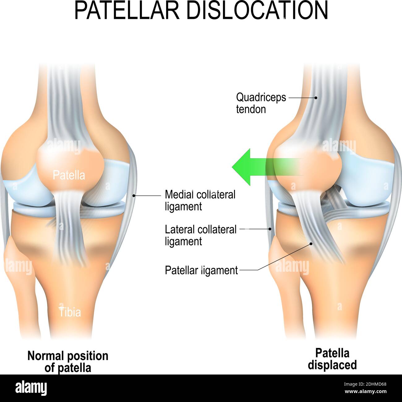 Dislocazione rotulea. Posizione normale della ginocchia e della rotula spostata. Anatomia del ginocchio Illustrazione Vettoriale