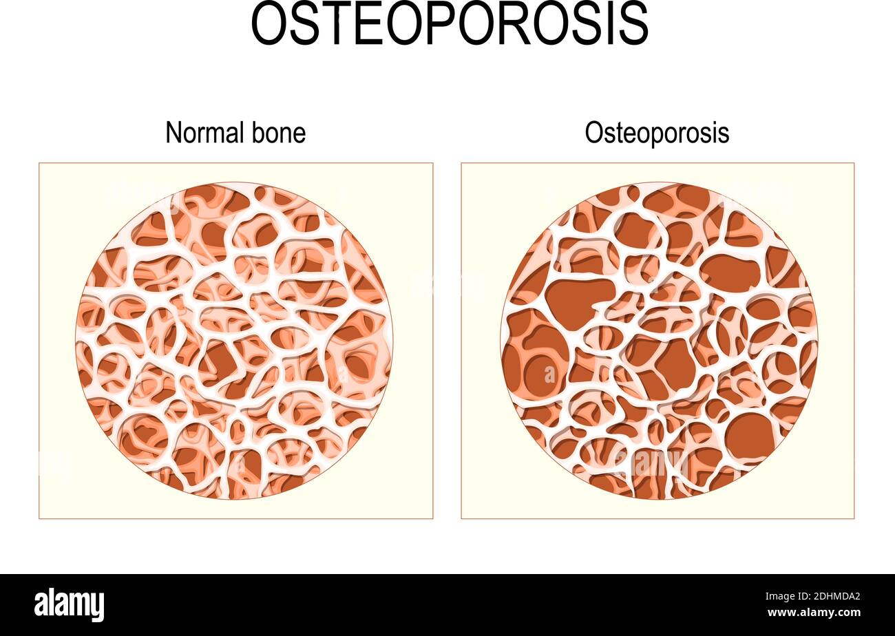 Struttura ossea. Normale e osteoporosi. Illustrazione medica. Illustrazione Vettoriale