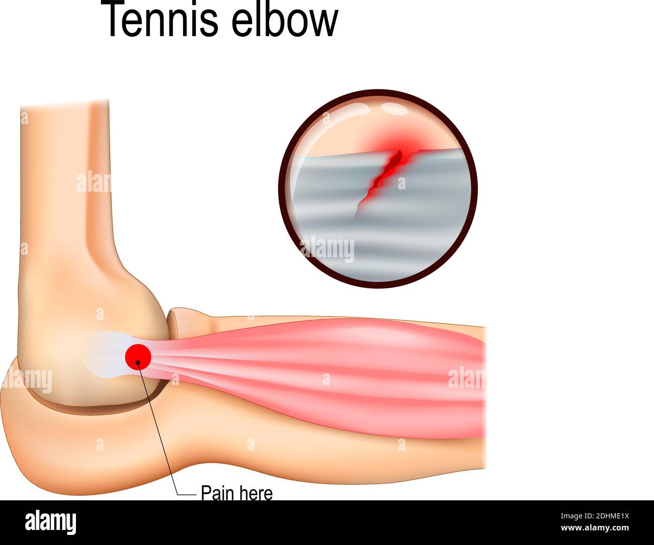 Gomito da tennis o epicondilite laterale. Illustrazione vettoriale per uso medico Illustrazione Vettoriale