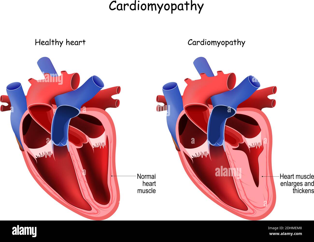 Cardiomiopatia. Cuore e cuore sani con muscolo ingrossato e addensato. Sezione trasversale del cuore umano Illustrazione Vettoriale