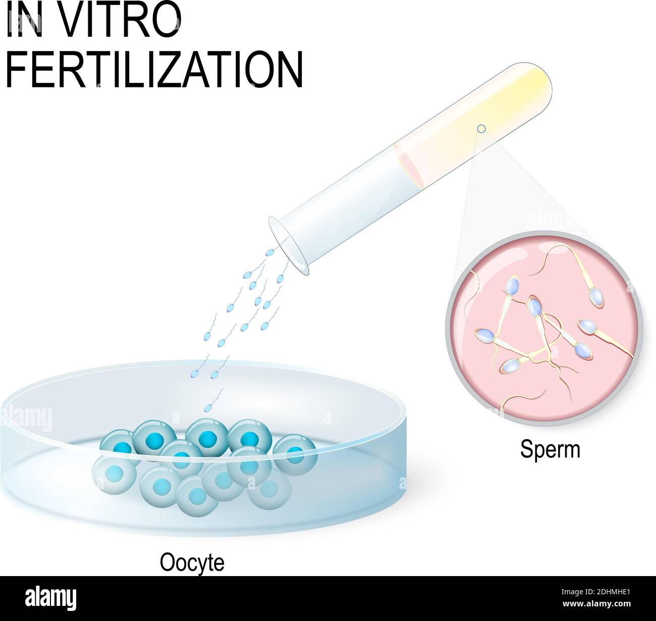 Fecondazione in vitro. Inseminazione artificiale. Piatto Petri con uova umane. Provetta per analisi con sperma. Illustrazione Vettoriale