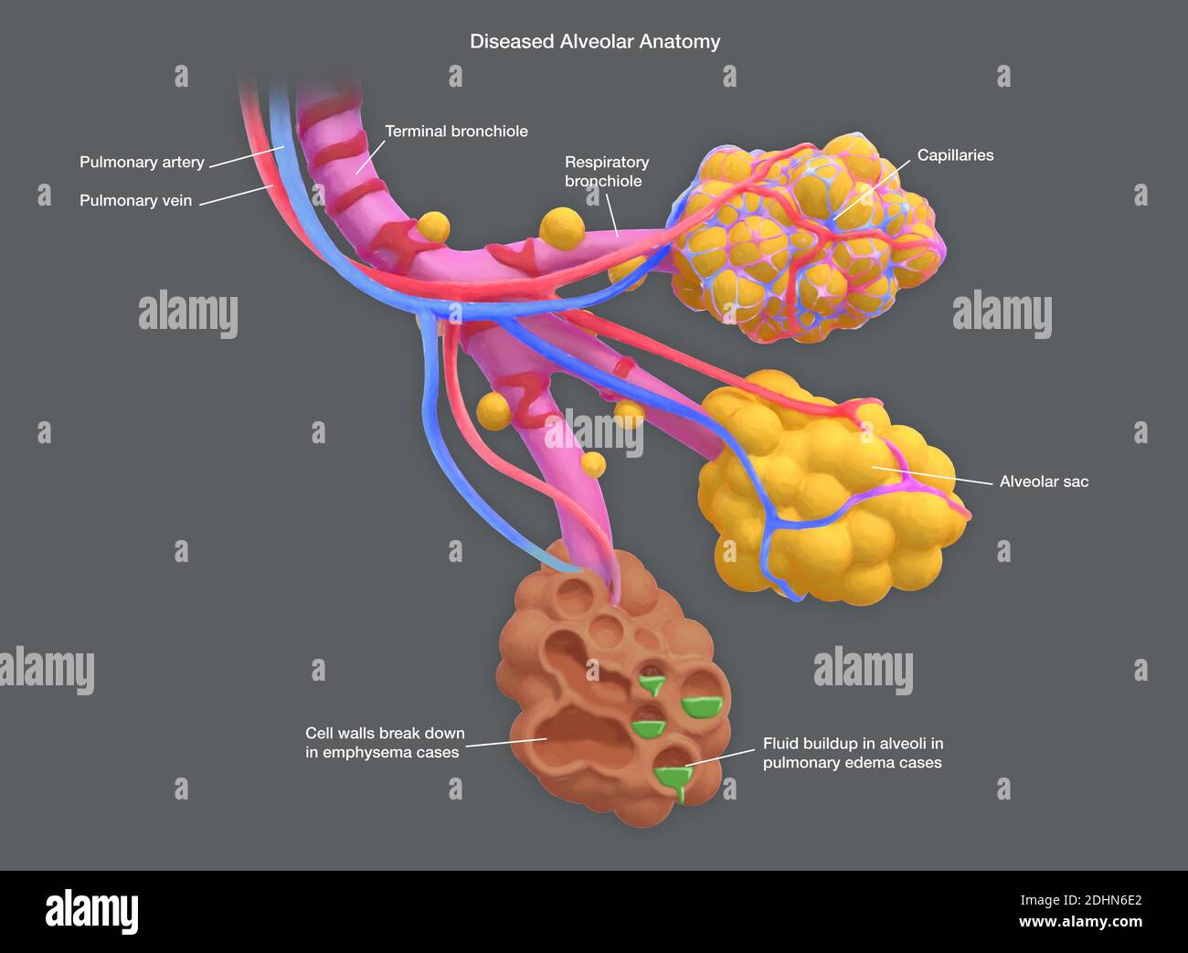 Illustrazione annotata di alveoli umani malati. Gli alveoli sono sacche d'aria nei polmoni, alle estremità dei bronchioli, che consentono lo scambio di ca Foto Stock