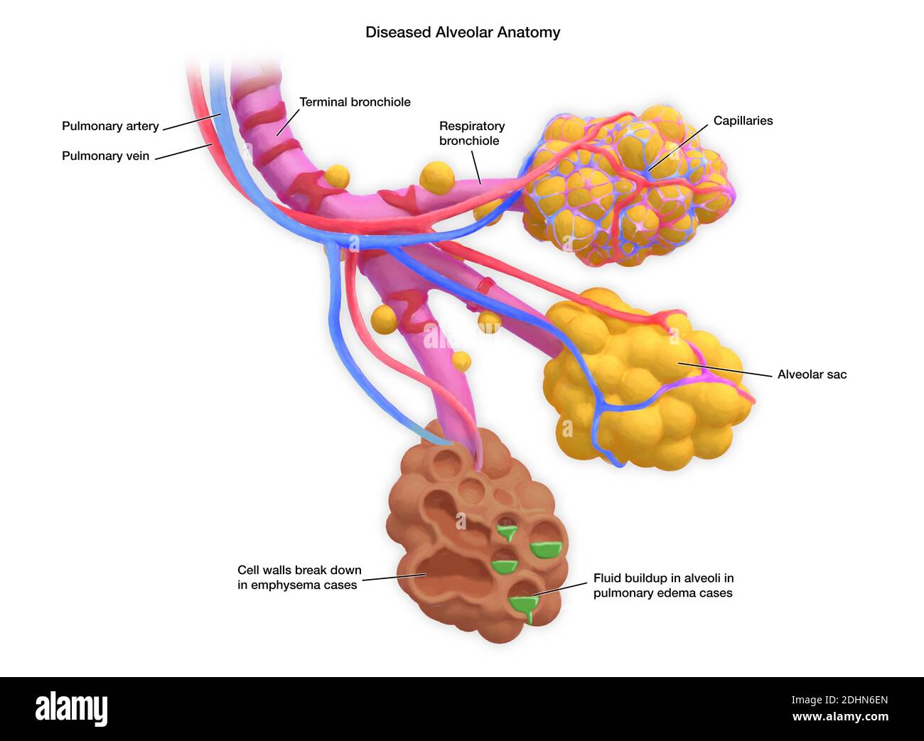 Annotato Illustrazione di alveoli umani malati. Gli alveoli sono sacche d'aria nei polmoni, alle estremità dei bronchioli, che consentono lo scambio di ca Foto Stock