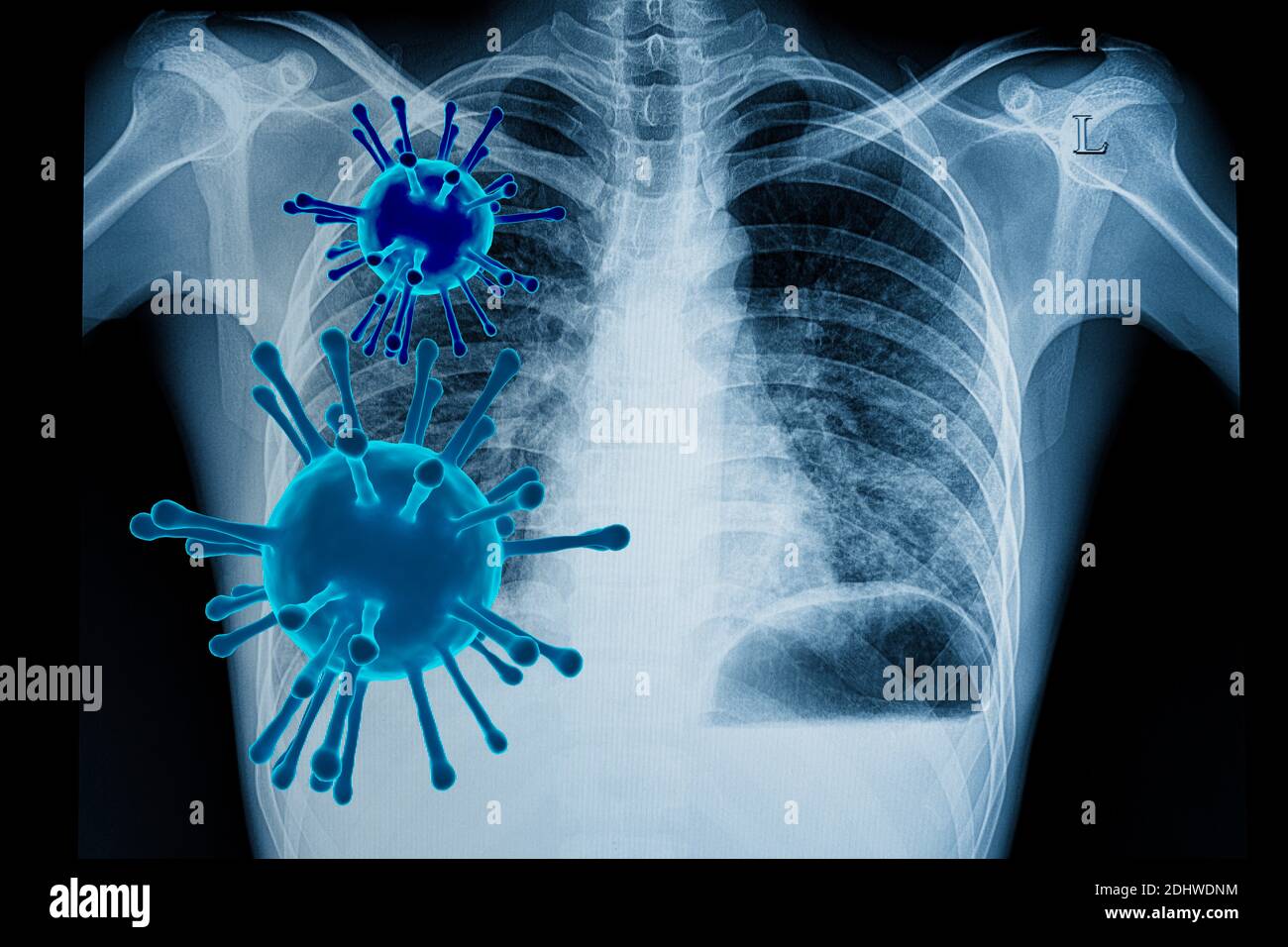Illustrazione visiva dell'infezione da coronavirus (covid-19) nei polmoni con Particelle virali 3D rese e una pellicola per raggi X toracici di un paziente con bilatera Foto Stock