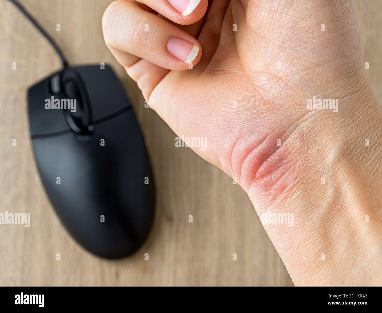 Rossore e callus o corn sul polso di una mano di donna caucasica, causato da un lungo lavoro con il mouse al computer. Malattie professionali. Foto Stock