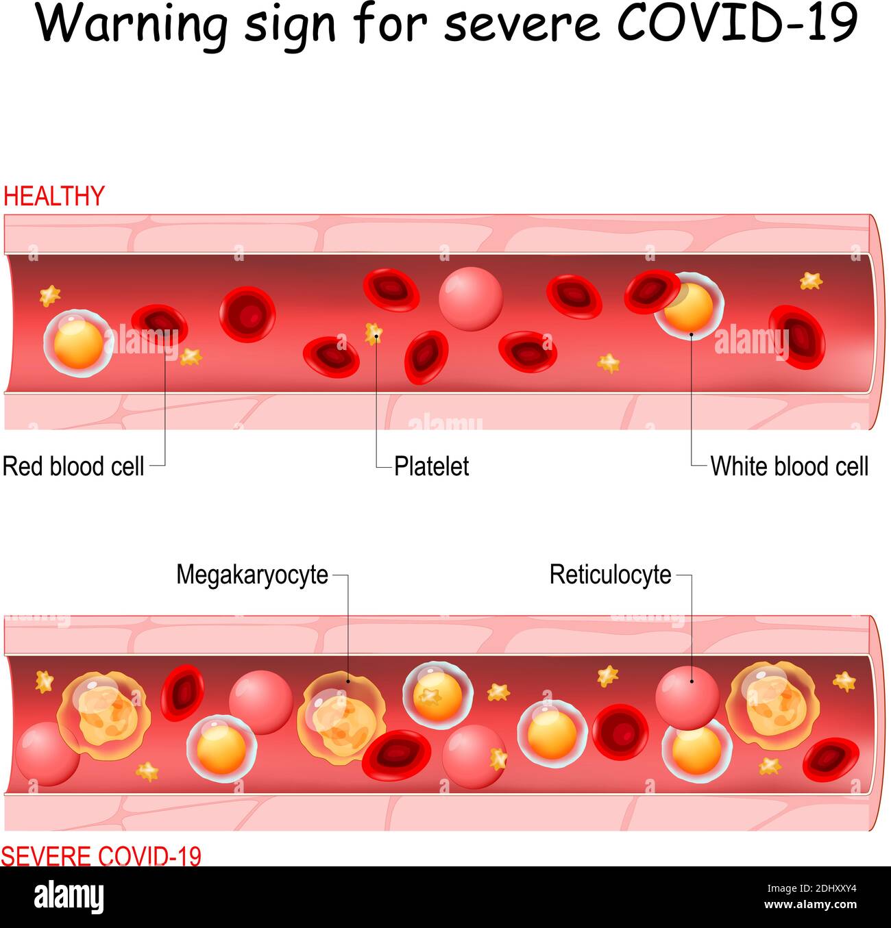 COVID-19. Segnale di avvertimento per sindrome respiratoria acuta grave coronavirus malattia individuazione di complicazioni gravi. Due vasi sanguigni Illustrazione Vettoriale