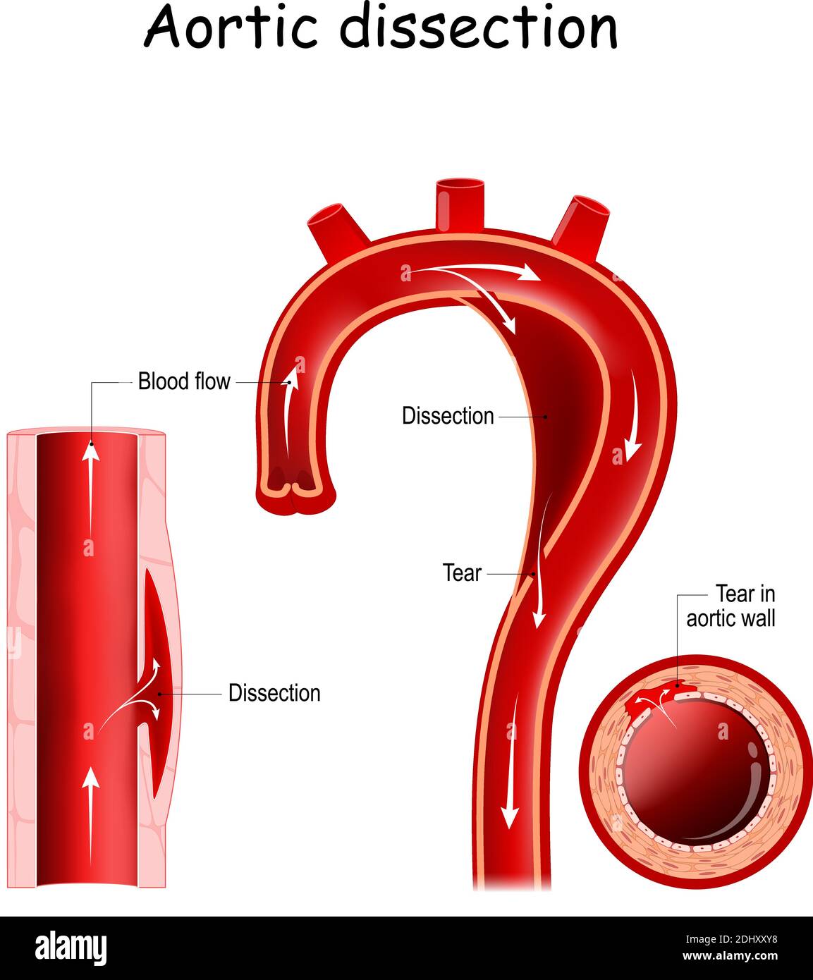 Dissezione aortica. Lesione allo strato più interno dell'aorta. Sangue a fluire tra gli strati della parete aortica. Arco aortico Illustrazione Vettoriale