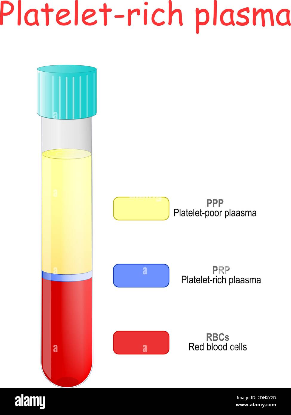 Plasma ricco di piastrine. Strati di sangue in una provetta di vetreria. Provetta per analisi con PRP. In vitro. Illustrazione Vettoriale