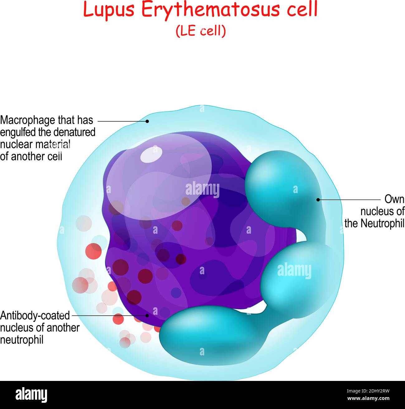 Lupus eritematoso. Struttura DELLA cella LE. Anatomia umana primo piano del neutrofilo o macrofago che ha inghiottito il materiale nucleare denaturato Illustrazione Vettoriale