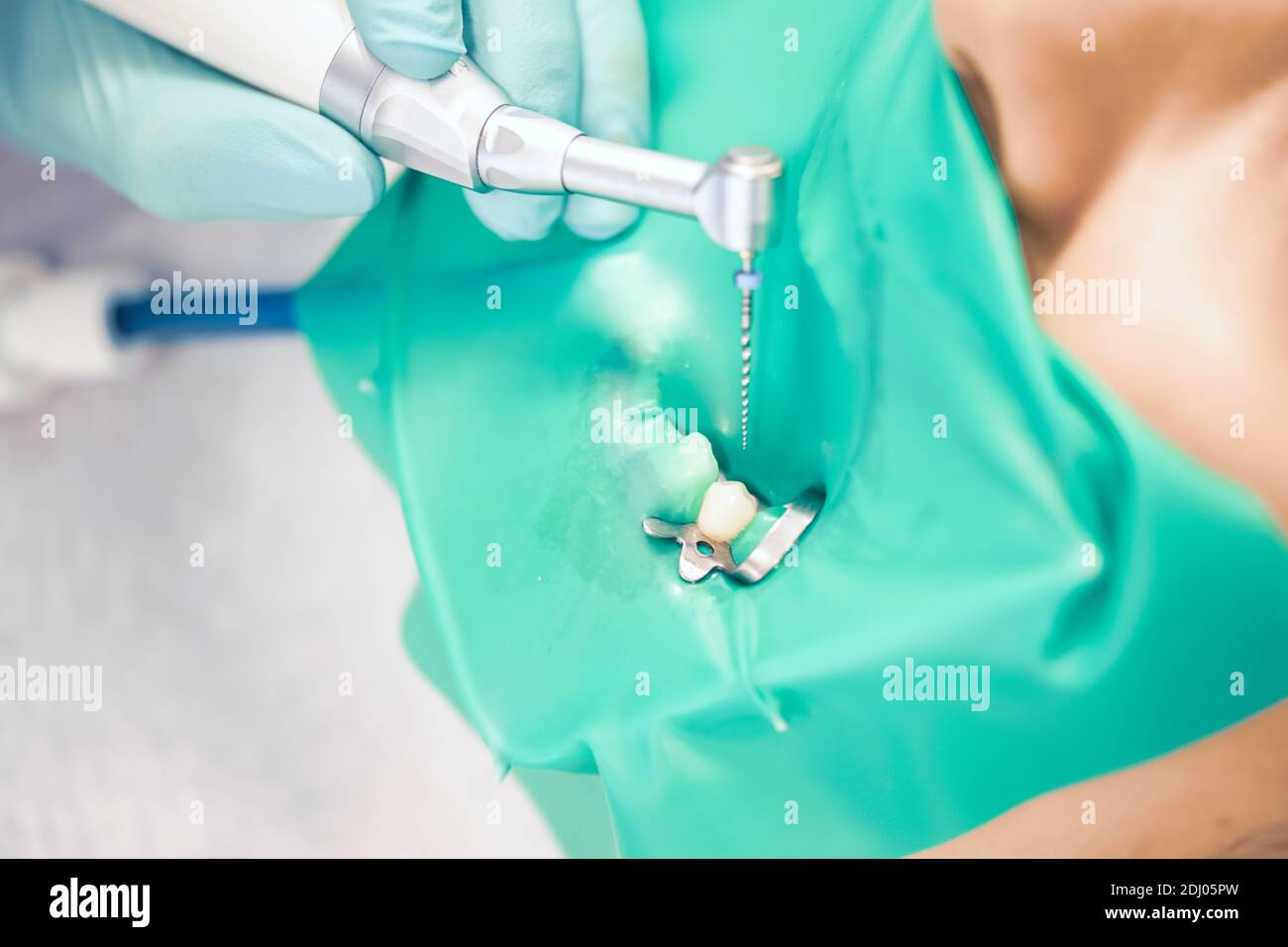 Trattamento di canali dentali nel molare inferiore permanente utilizzando una lima di localizzazione apicale, un dente con una clip fissata ad esso con una diga di caffè. Foto Stock