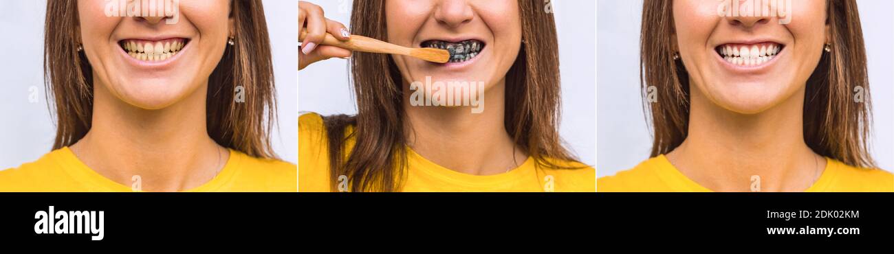 Denti gialli e bianchi prima e dopo. Dentifricio sbiancante al carbone nero  Foto stock - Alamy