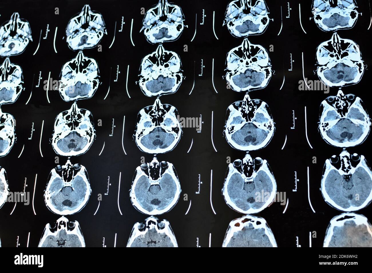 Scansione dell'immagine tomografica computerizzata del cervello. Pellicola TC di un cranio umano e di un cervello con shunt intracranico. Background neurologico. Medicina, scienza. Foto Stock