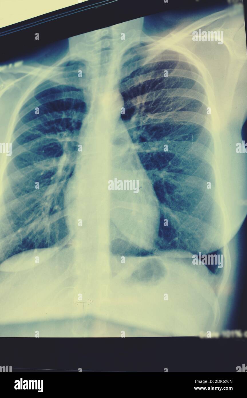 Una scansione delle immagini radiografiche dei polmoni. Pellicola radiografica del torace o del polmone del paziente per la diagnosi medica. Medicina polmonare, scienza. Foto Stock
