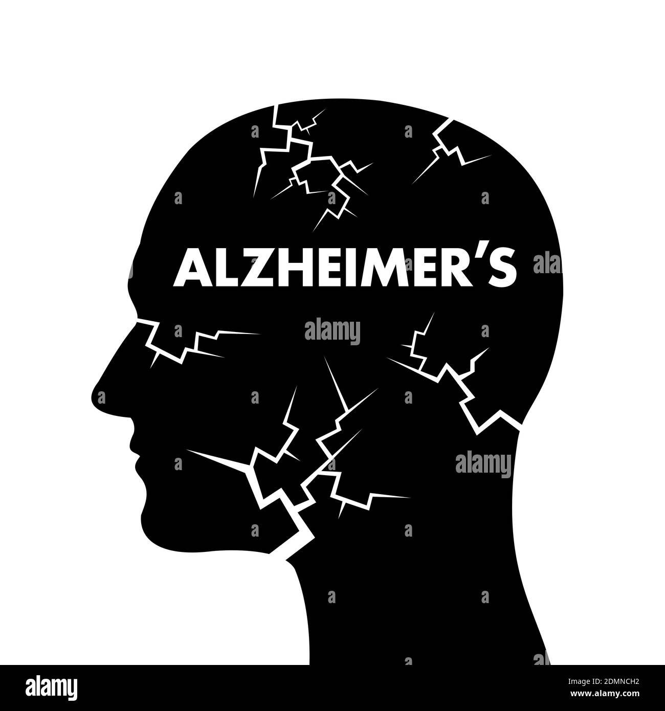 Malattia di Alzheimer - deterioramento, degenerazione, decadimento e declino del cervello e della mente nella testa dell'uomo e dell'uomo. Illustrazione vettoriale Foto Stock
