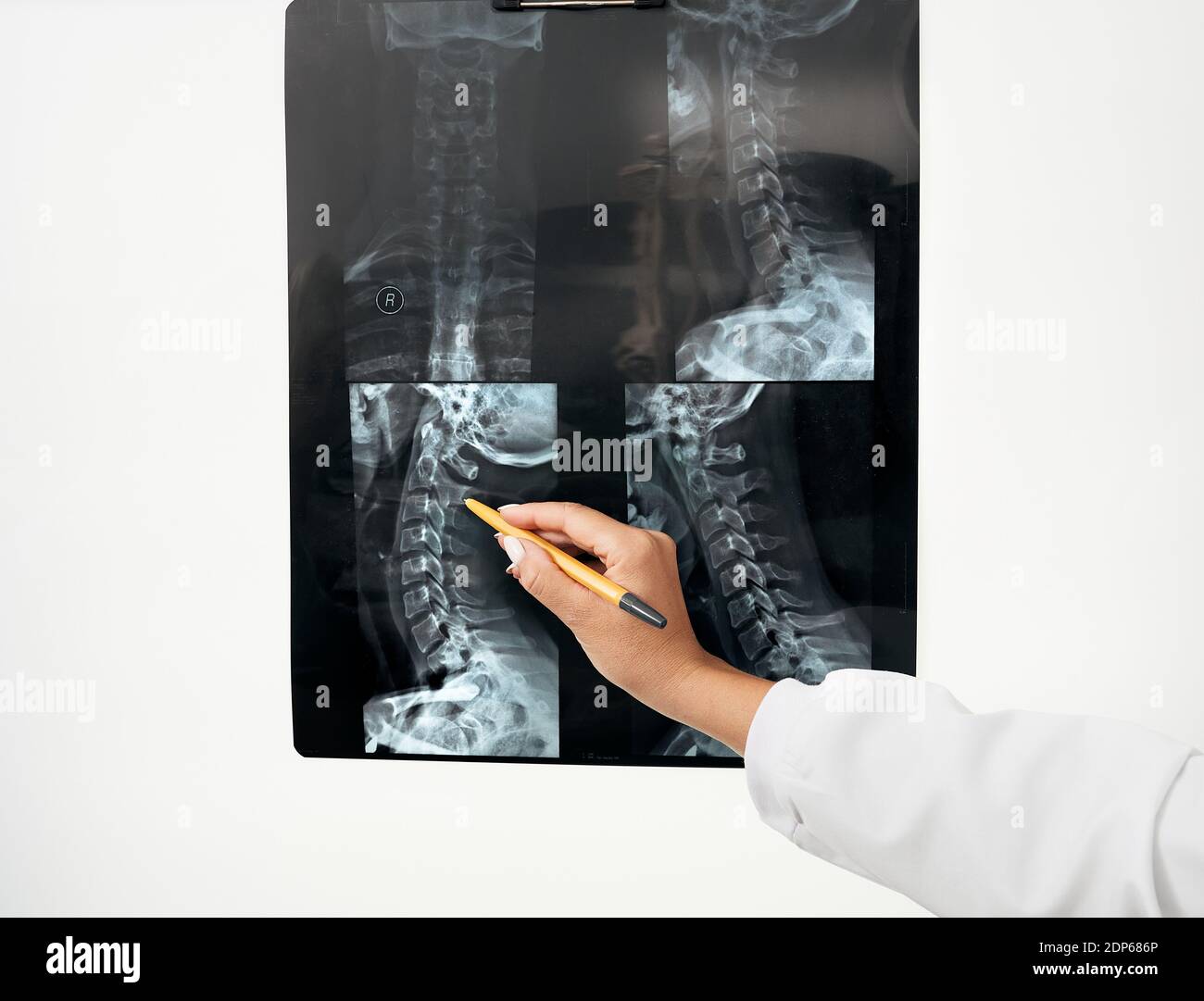 il medico neurologo esamina l'immagine radiografica della colonna cervicale del paziente utilizzando il negatoscopio. Trattamento della malattia della colonna vertebrale e osteocondrosi Foto Stock