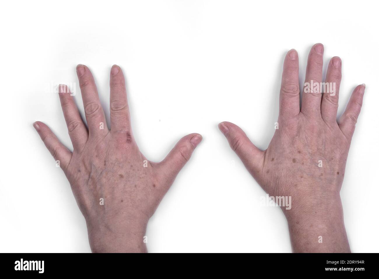Vecchie mani femminili con macchie e ferite Foto Stock