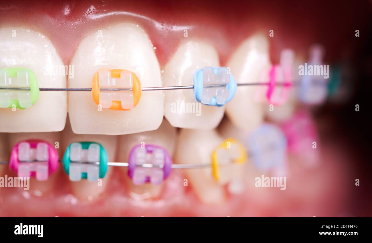 Macro istantanea di occlusione dentale, denti e bretelle in ceramica con bande colorate in gomma su di essi. Concetto di igiene dentale, odontoiatria e trattamento ortodontico. Foto Stock