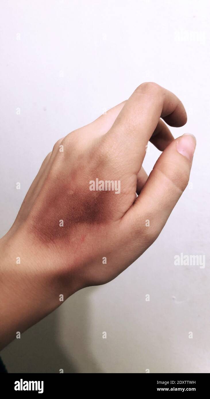 Primo piano della mano tagliata con macchie scure contro la parete Foto  stock - Alamy