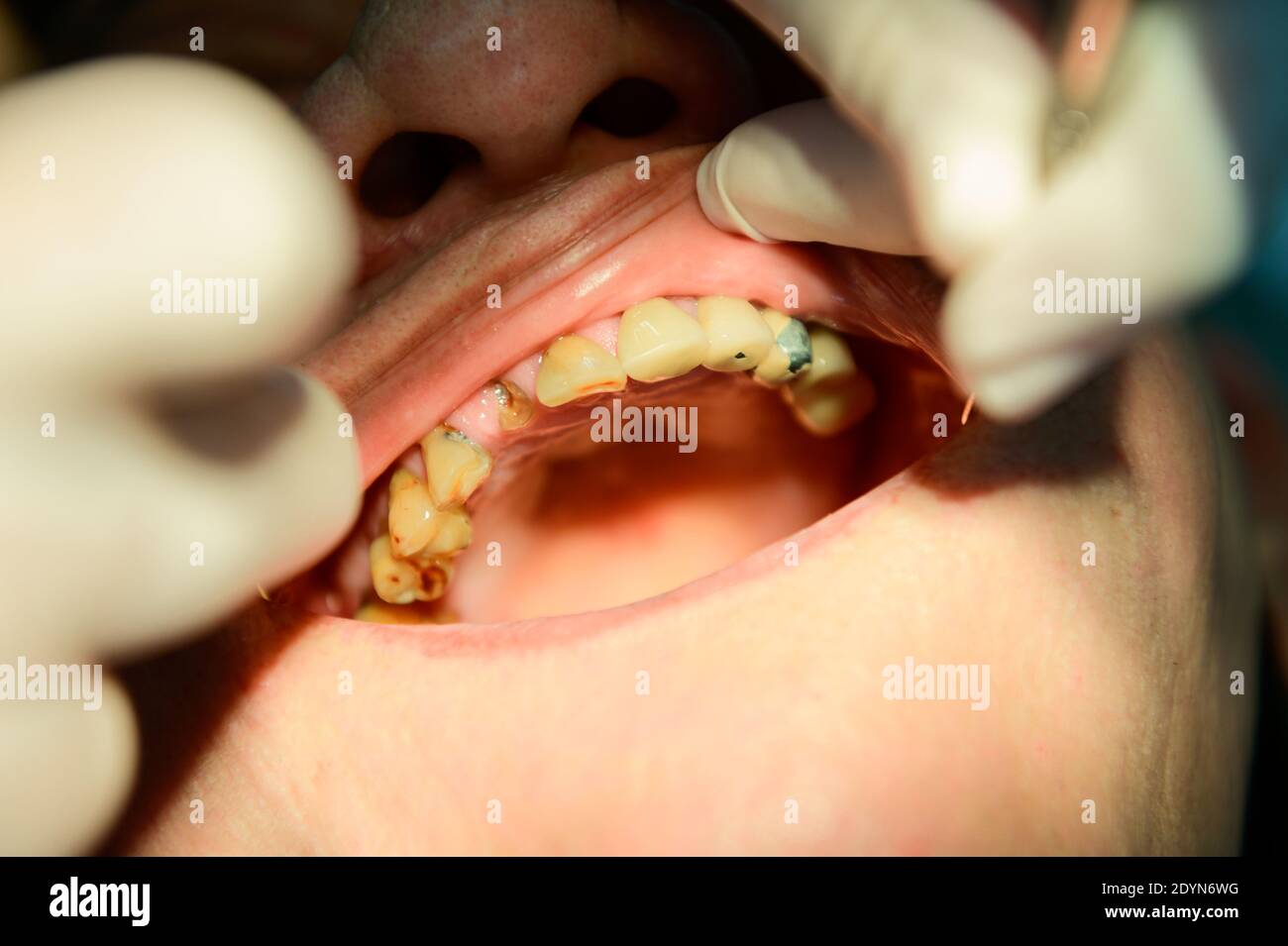 Bocca ravvicinata per mostrare la decadenza dei denti delle cavità Foto Stock