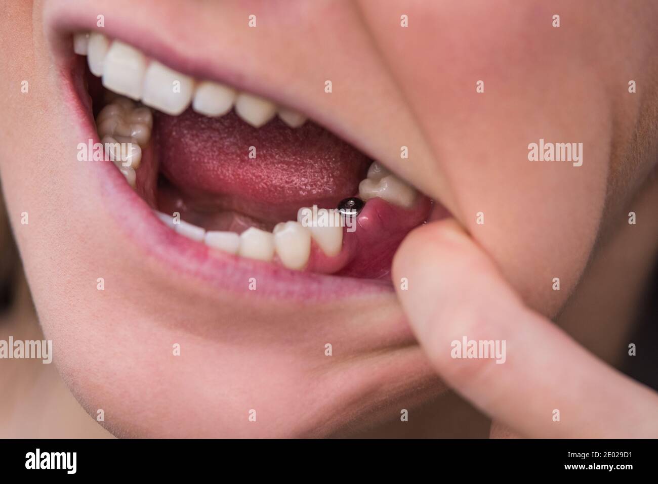 Closeup dell'impianto a dente singolo. Giovane donna senza dente sulla mascella inferiore. Dente mancante. Impianto dopo l'estrazione dei denti. Foto Stock