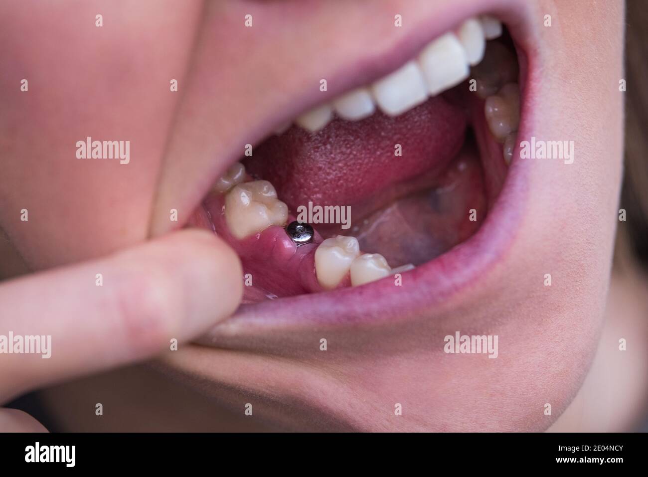Giovane donna senza dente sulla mascella inferiore. Dente mancante. In attesa dell'impianto dopo l'estrazione del dente. Foto Stock