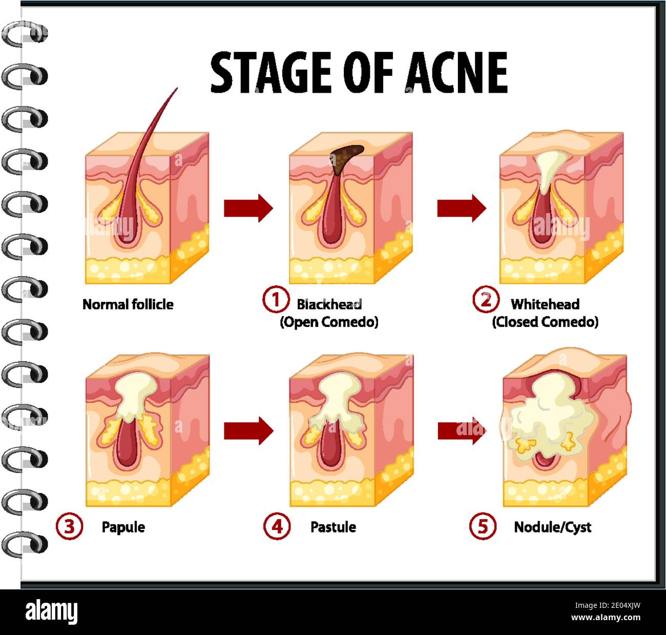 Fasi dell'illustrazione dell'anatomia dell'acne della pelle Immagine e  Vettoriale - Alamy