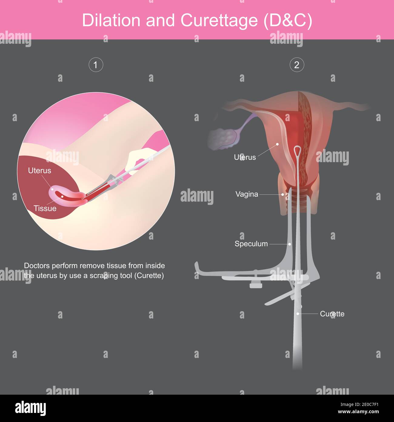 Dilatazione e curettage. I medici eseguono la rimozione del tessuto dall'interno dell'utero utilizzando uno strumento di raschiatura. Illustrazione Vettoriale