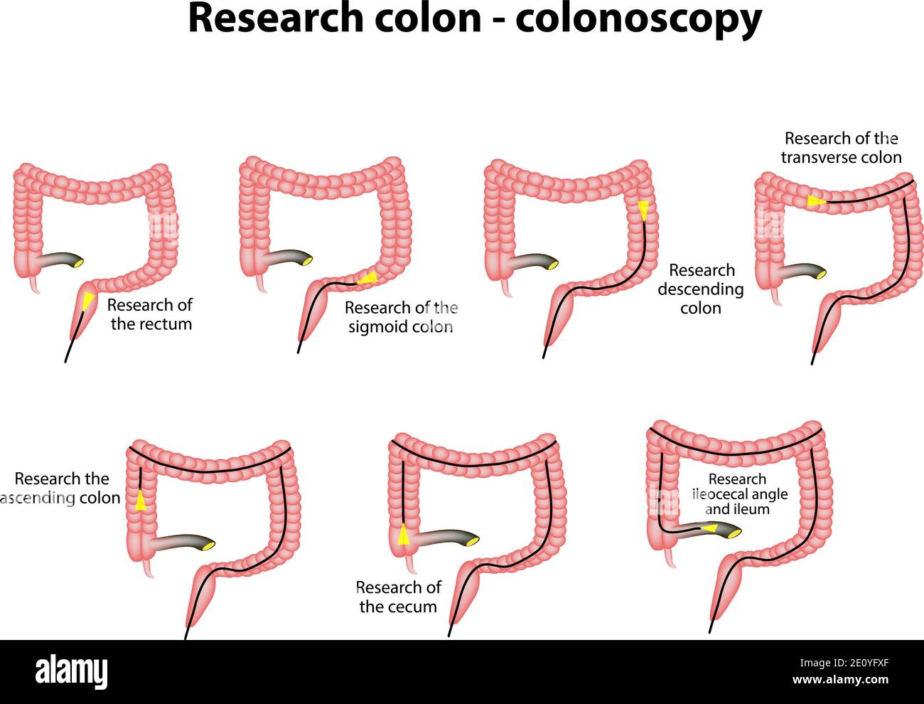Colonscopia. Diagnosi del colon. Infografiche. Illustrazione vettoriale su sfondo isolato Illustrazione Vettoriale