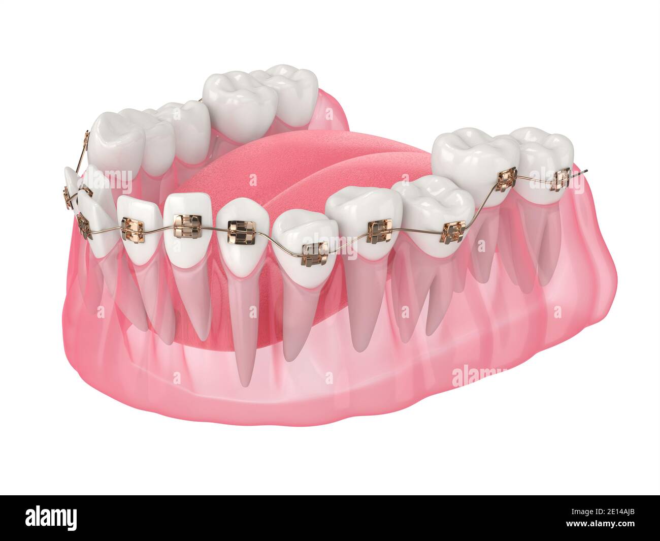 rendering 3d dell'allineamento dei denti tramite parentesi graffe ortodontiche su bianco sfondo Foto Stock