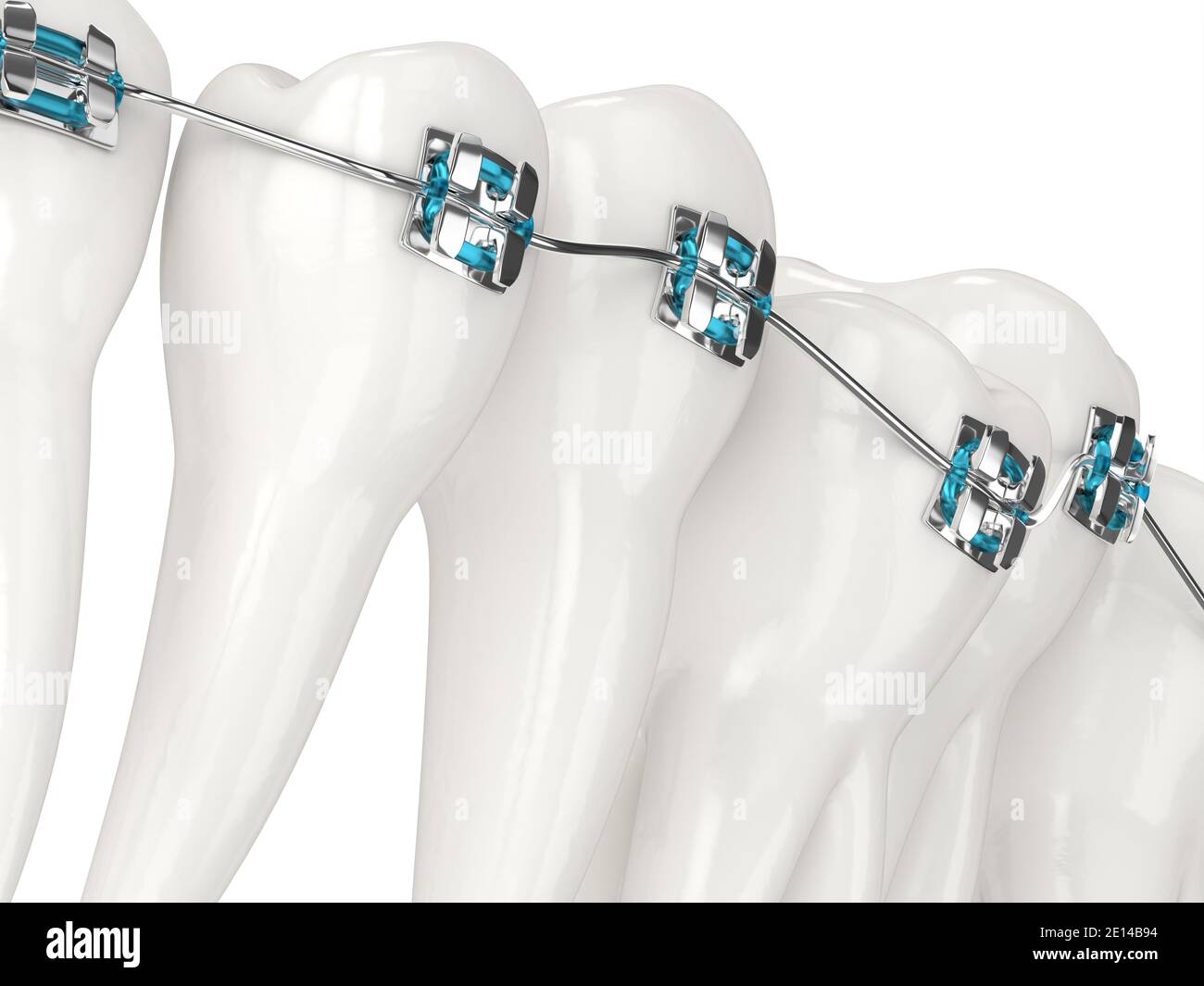 rendering 3d dell'allineamento dei denti tramite parentesi graffe ortodontiche su bianco sfondo Foto Stock