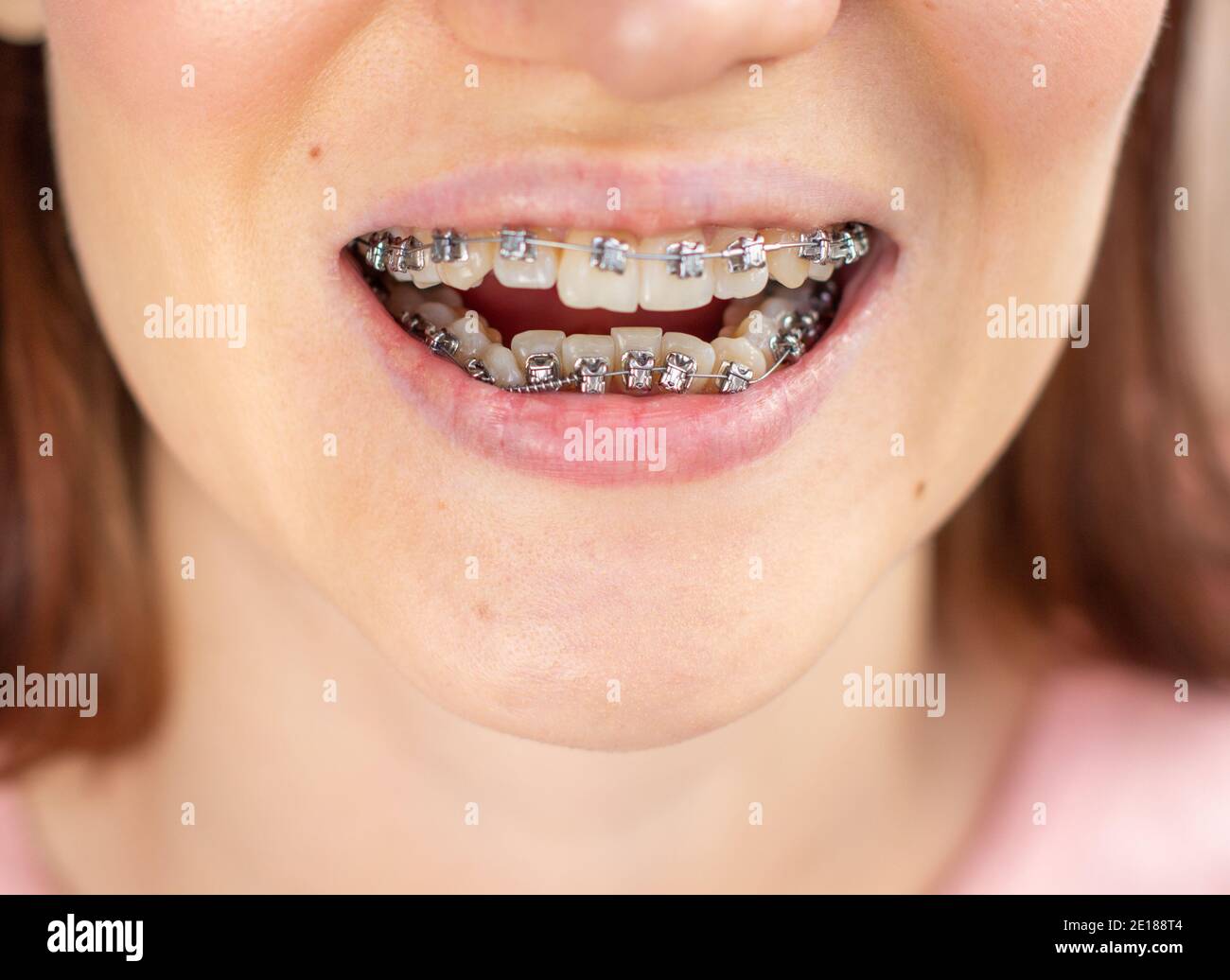 sistema a scrigno in bocca sorridente, macro denti foto, primo piano labbra, macro shot. Foto Stock