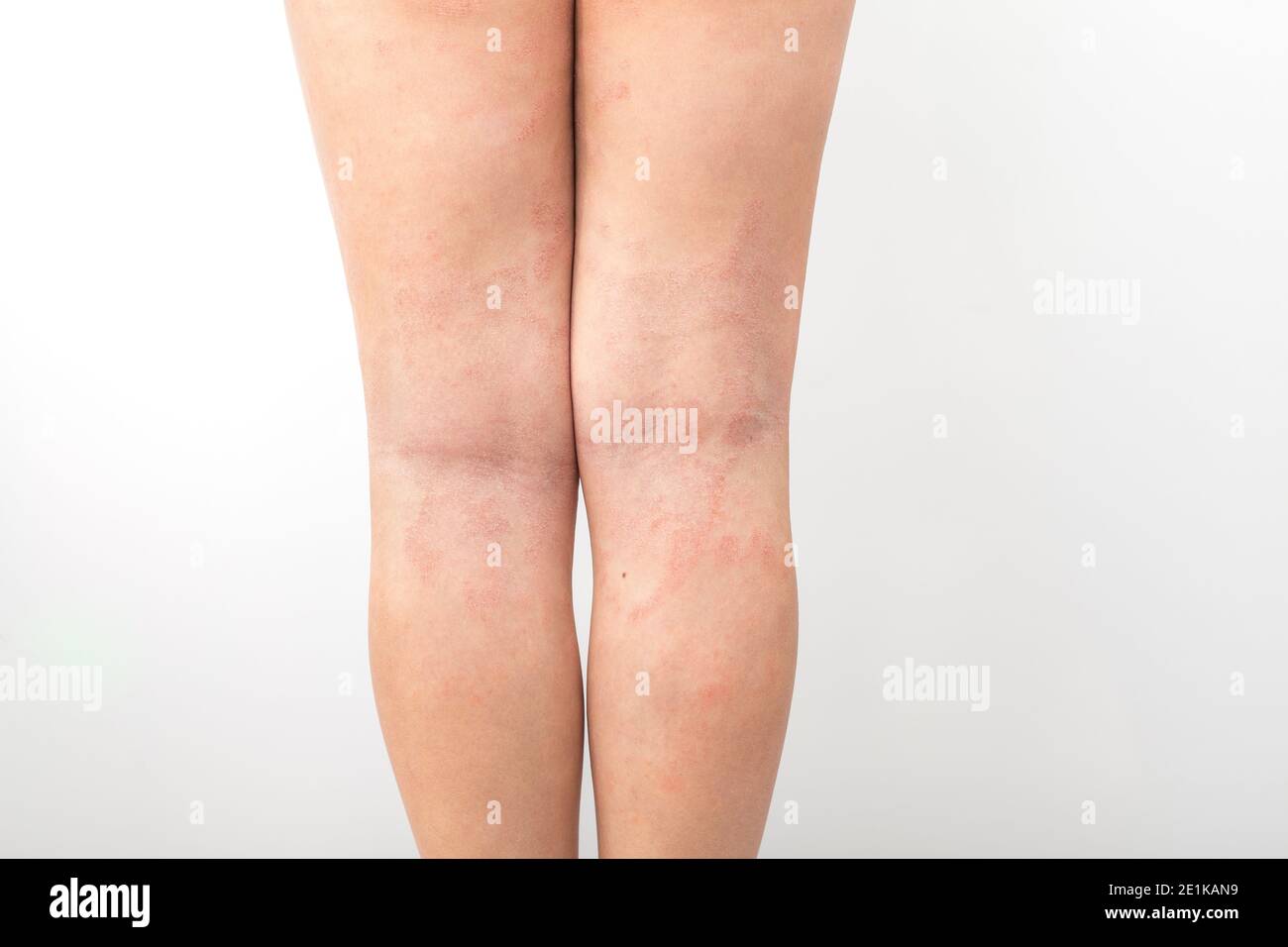 La dermatite atopica acuta sulle gambe dietro le ginocchia di un bambino è  una malattia dermatologica della pelle. Eruzione cutanea grande, rossa,  infiammata e scalosa sulle gambe Foto stock - Alamy